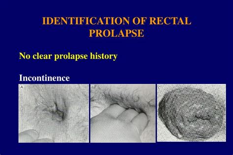 anal gaping prolapse|'gaping anal prolapse' Search .